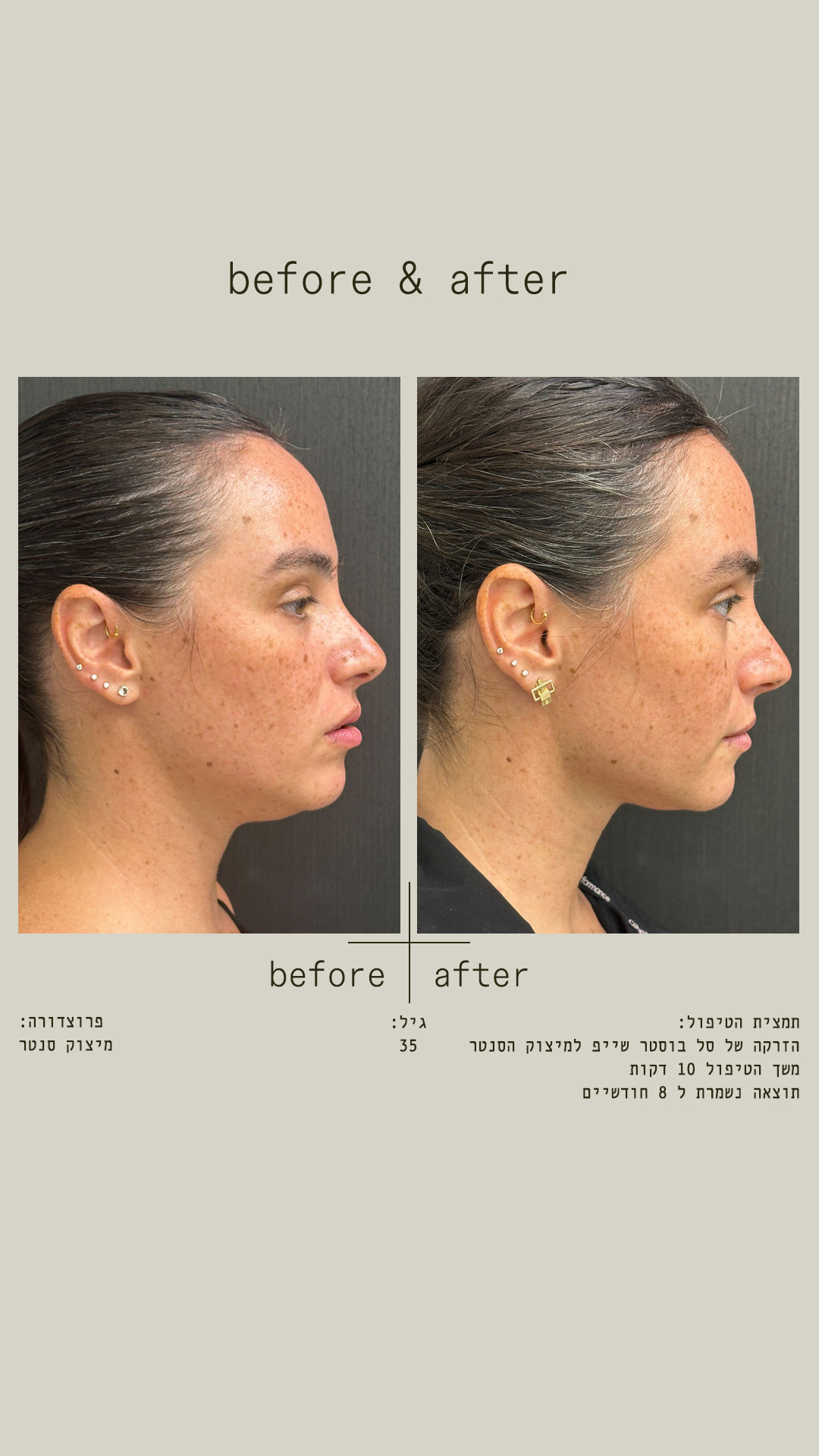 הזרקת חומצה היאלורונית - לפני ואחרי - Liran Alon MD - Plastic Surgeon