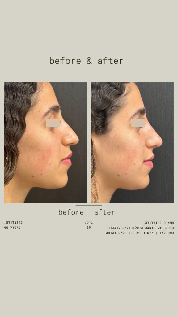 פיסול אף - הזרקה של חומצה היאלורונית לגבנון האף לצורך יישור, עידון הטיפ והרמה - מבט מימין