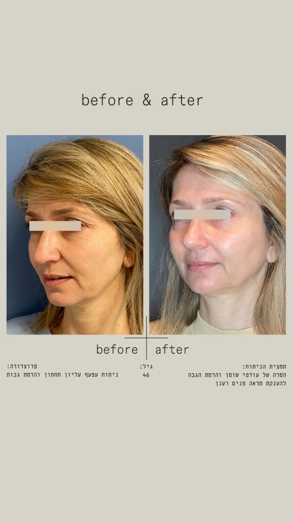 ניתוח עפעף עליון, עפעף תחתון והרמת גבות