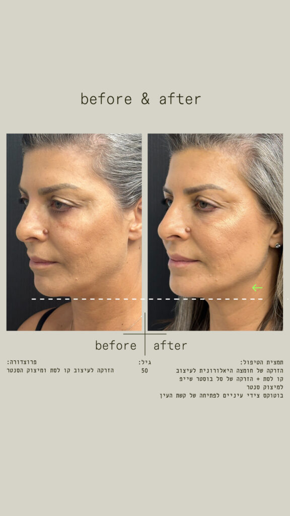 הזרקה של חומצה היאלורונית לעיצוב קו לסת + הזרקה של סל בוסטר שייפ למיצוק סנטר. בוטוקס צידי עיניים לפתיחה של קשת העין.