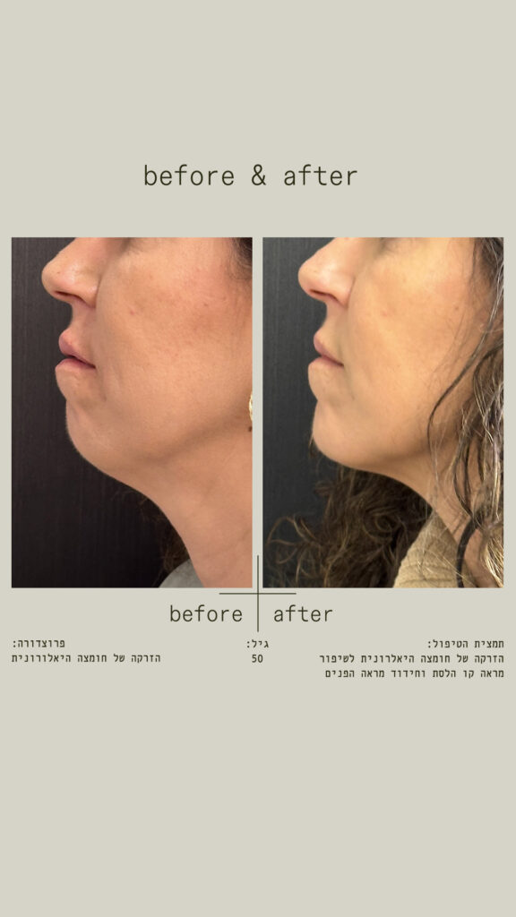 הזרקה של חומצה היאלורונית לשיפור מראה קו הלסת וחידוד מראה הפנים.