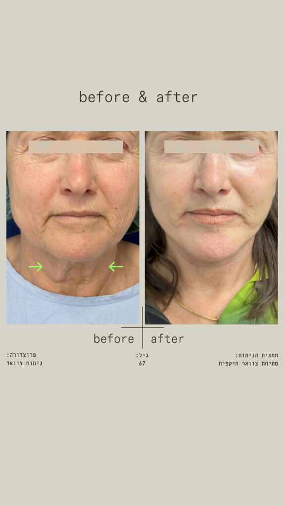 ניתוח צוואר - מתיחת צוואר היקפית - צוואר קדמי