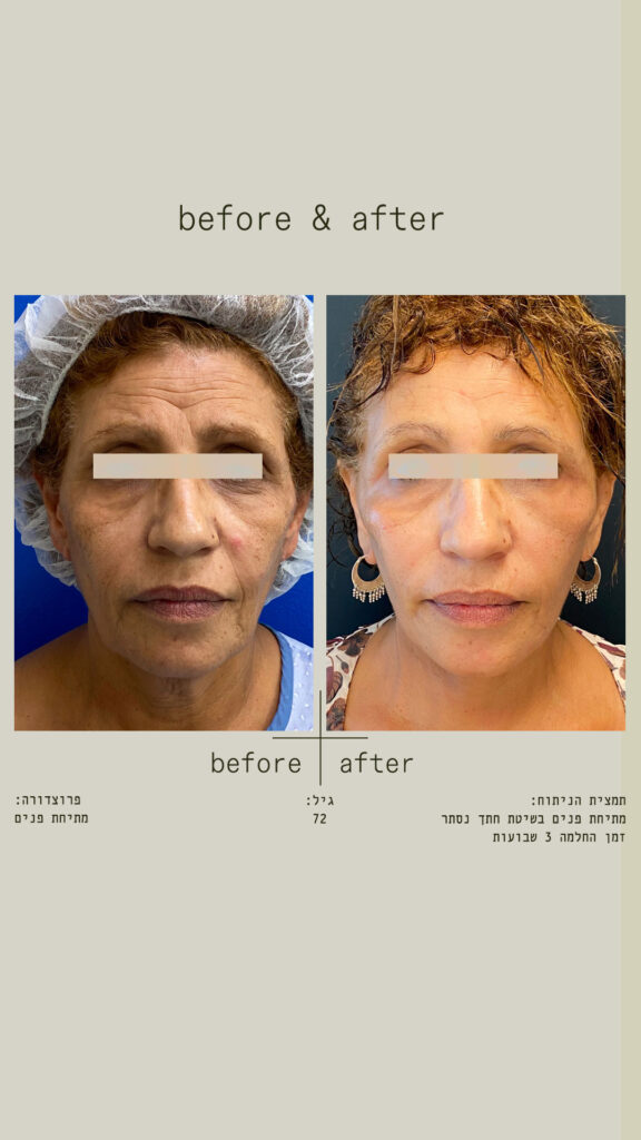 מתיחת פנים בשיטת חתך נסתר