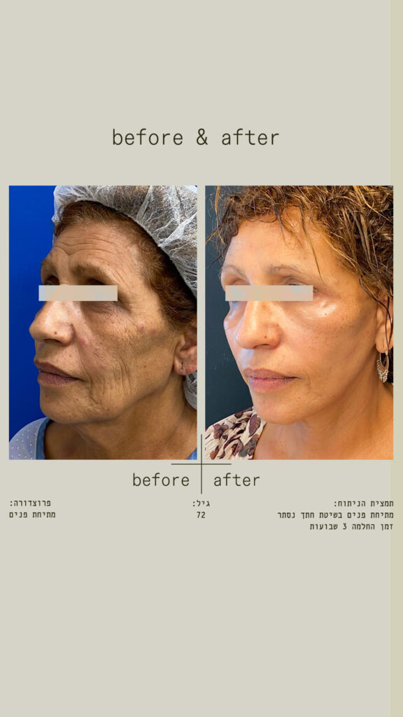 מתיחת פנים בשיטת חתך נסתר