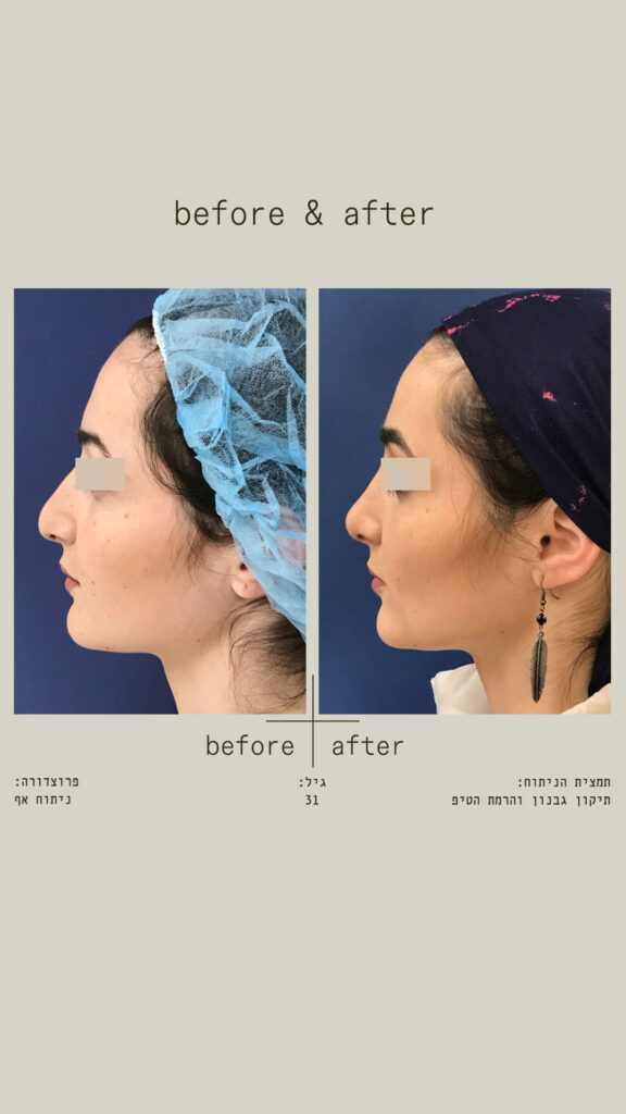 ניתוח אף - תיקון גבנון והרמת הטיפ - מבט מצד שמאל.