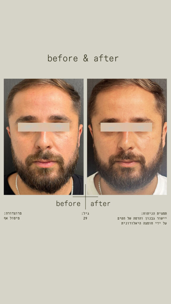 פיסול אף - יישור גבנון והרמה של הטיפ על ידי חומצה היאלורונית - מבט מלפנים