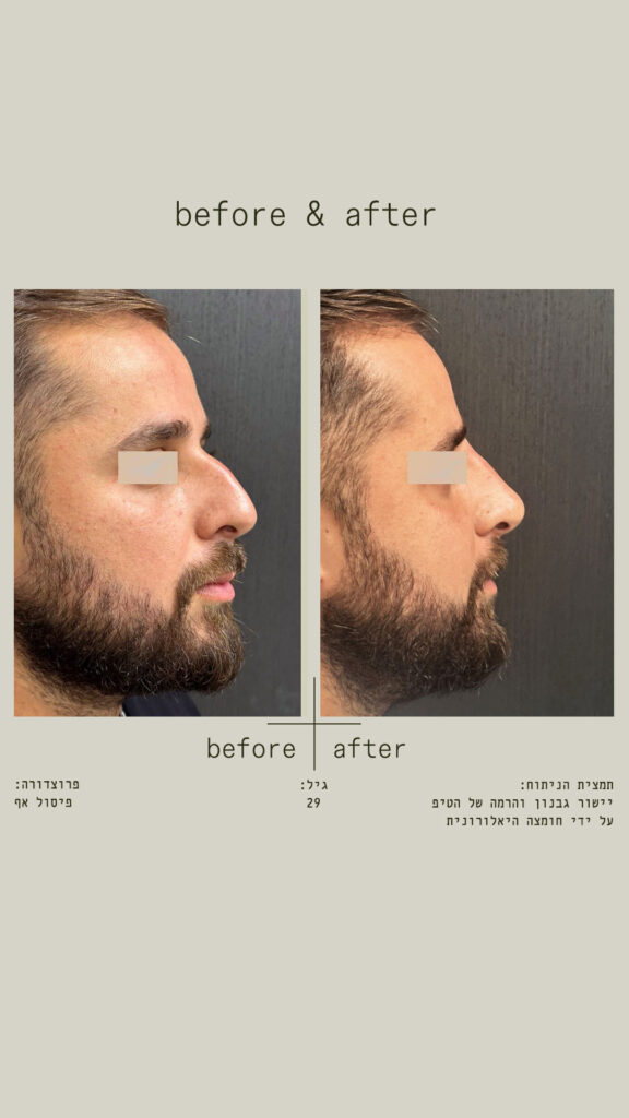 פיסול אף - יישור גבנון והרמה של הטיפ על ידי חומצה היאלורונית - מבט מימין