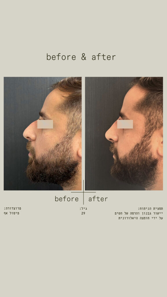 פיסול אף - יישור גבנון והרמה של הטיפ על ידי חומצה היאלורונית - מבט מצד שמאל