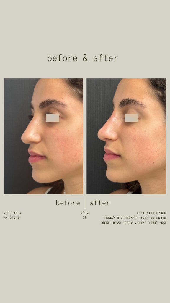 פיסול אף - הזרקה של חומצה היאלורונית לגבנון האף לצורך יישור, עידון הטיפ והרמה - מבט משמאל
