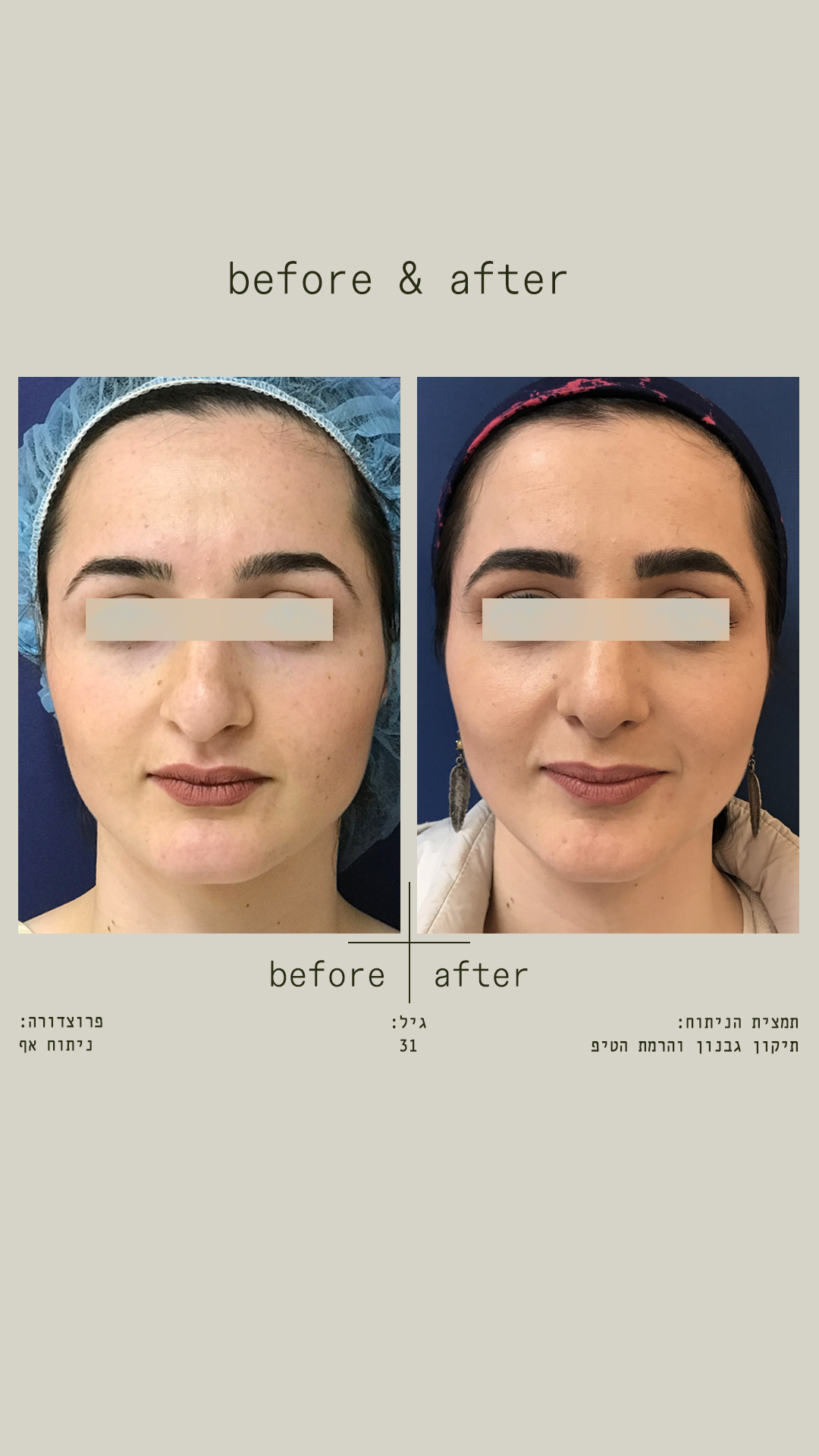 ניתוח אף - לפני ואחרי - Liran Alon MD - Plastic Surgeon