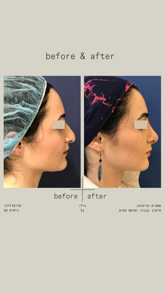 תמונת לפני ואחרי ניתוח אף