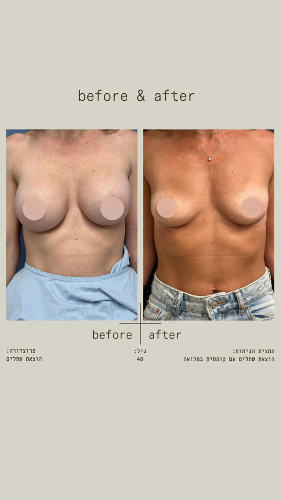הוצאת שתלים עם קופסית במלואה - מבט מלפנים