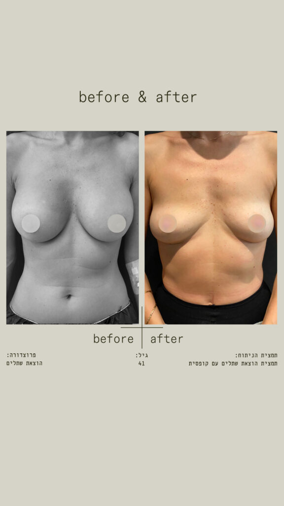 הוצאת שתלים עם קופסית.
