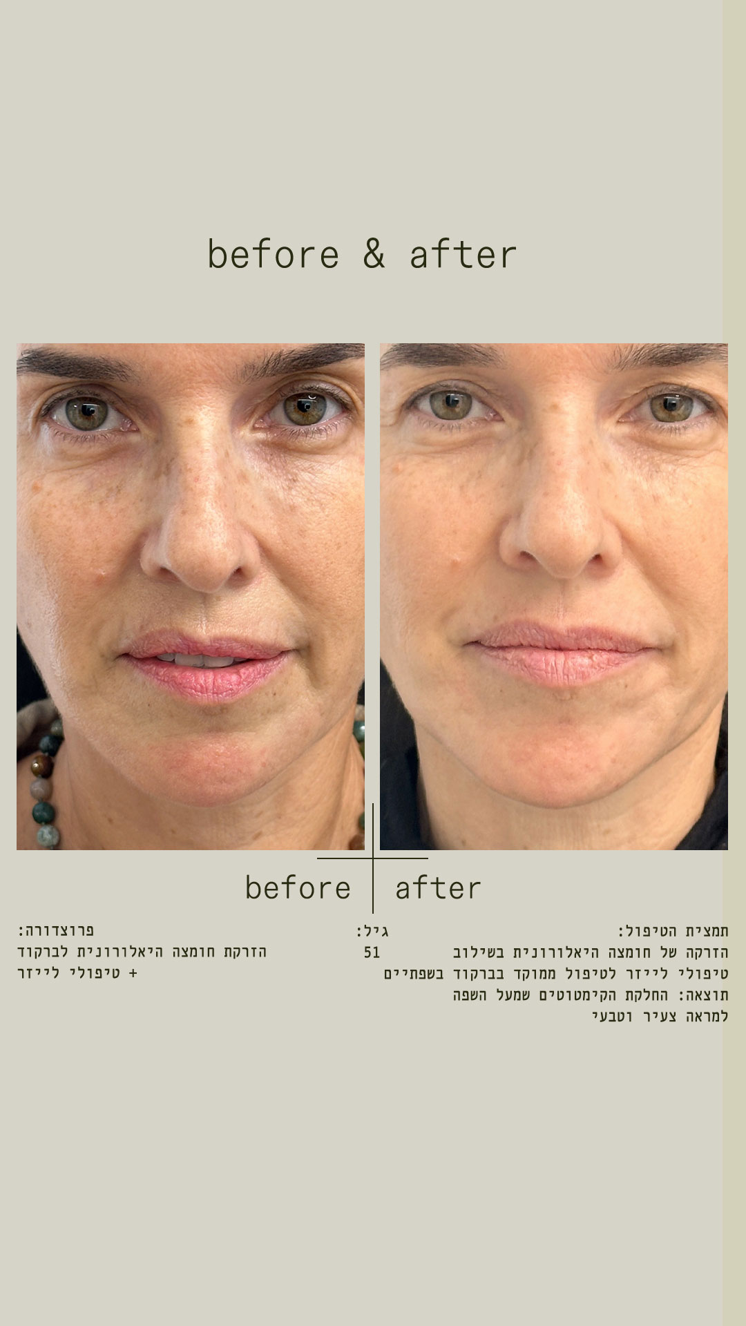 הזרקת חומצה היאלורונית - לפני ואחרי - Liran Alon MD - Plastic Surgeon