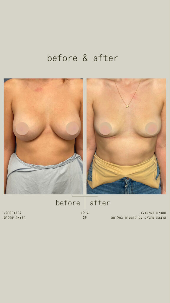 הוצאת שתלים עם קופסית במלואה.