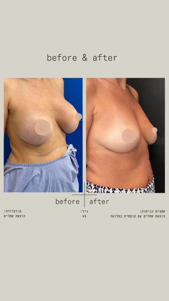 הוצאת שתלים עם קופסית במלואה.