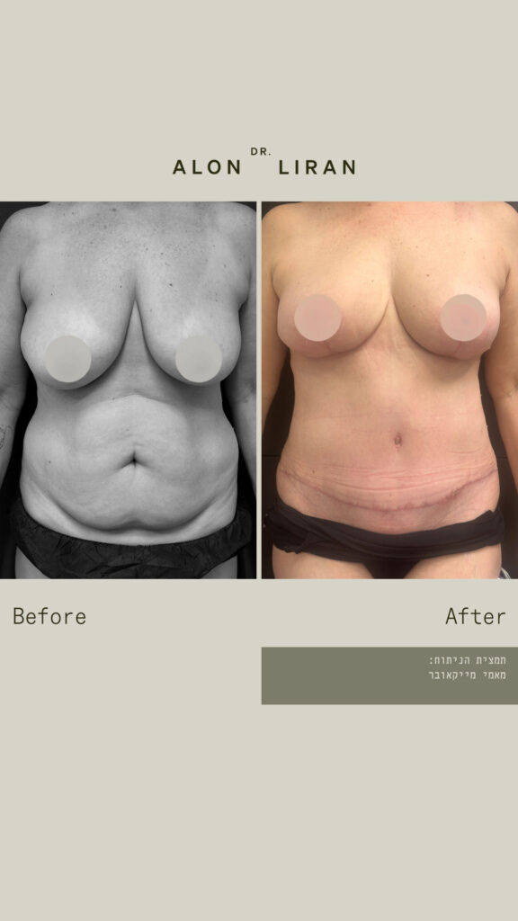 מאמי מייקאובר - לפני ואחרי - מבט מקדימה